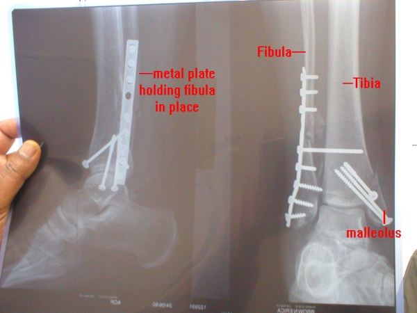 2nd x-ray