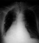 Aortic aneurysm