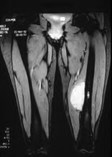 Ewing's sarcoma
