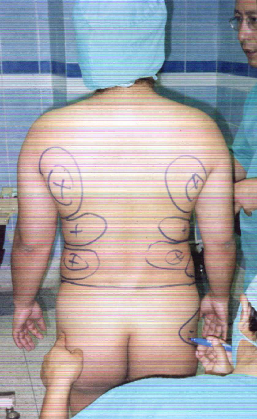 Para conocer m�s de liposucci�n haga click en cualquiera de las fotos.