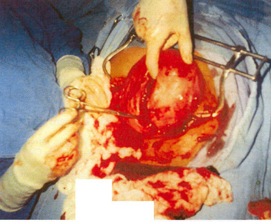 Exploraci&oacute;n abdominal y reparaci&oacute;n uterina