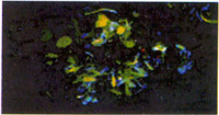 neuritas distroficas