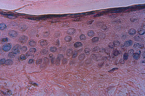 Ausencia melanocitos
