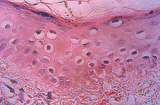 Melanocitis abundantes