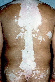 Vitiligo Vulgar
