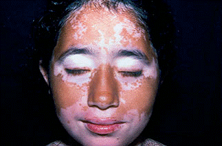 Facial