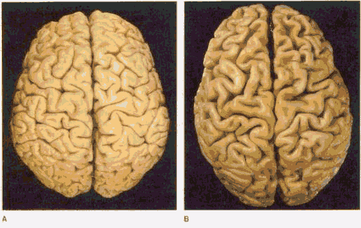Brain of an Alzheimer's victim.