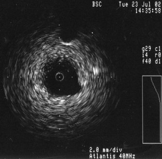 IVUS image