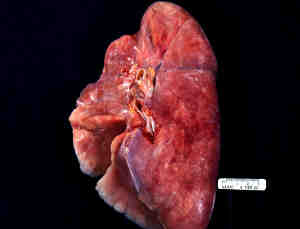 Lung.jpeg