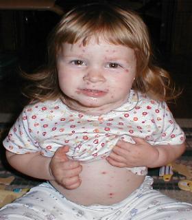 Taryn with the pox