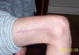 Khod's scar