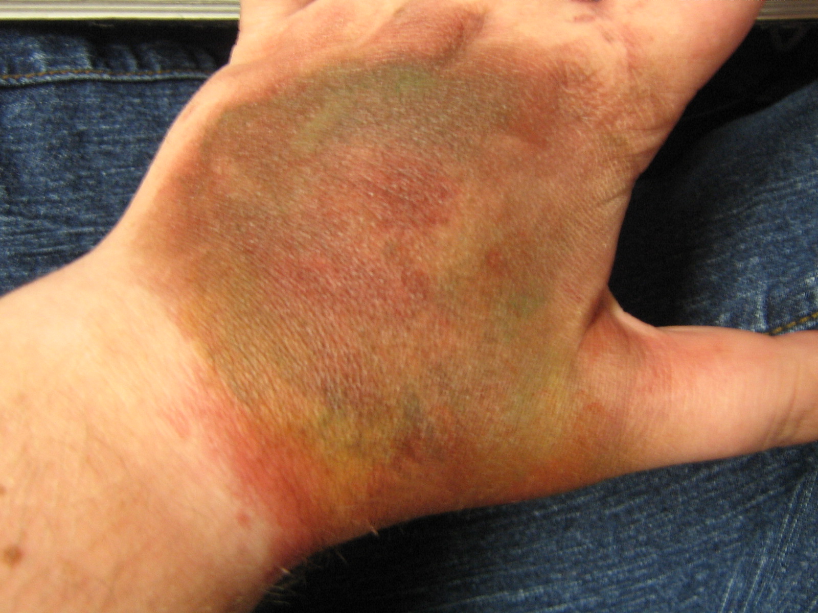 chemical burn on hands chemical burn on hands