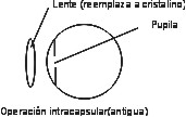 Intracapsular.jpg (6380 bytes)