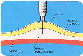 ESQUEMA DE LA ZONA A INYECTARSE