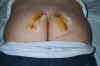 Surgery_Cuts_xxadrian_20020608_233355_rev__.jpg (22621 bytes)