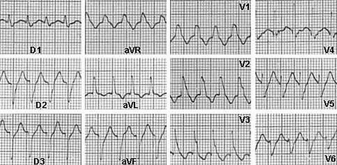 EKG 1 - Ventricular Tachycardia