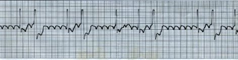 Atrial Flutter