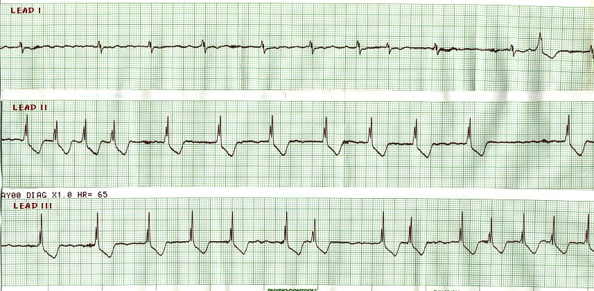 A. Fib with BBB