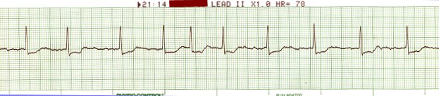 Atrial Fibrillation