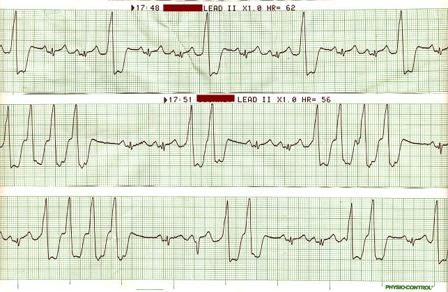 Sinus with frequent Ventricular Ectopics