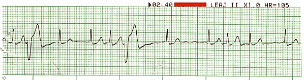 PVCs and PACs