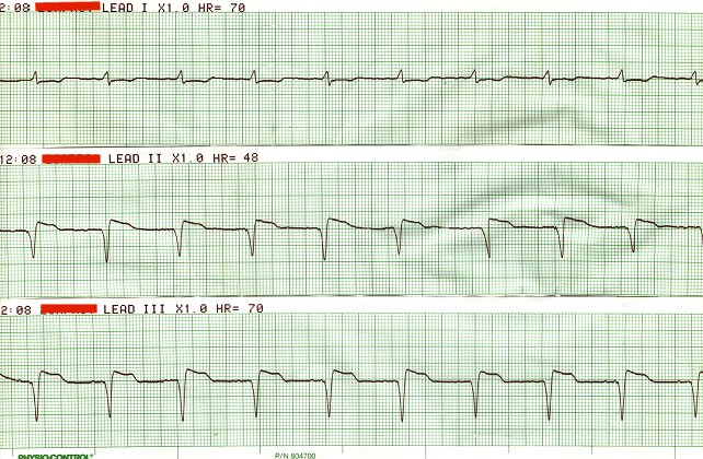 Bradyrhythmia