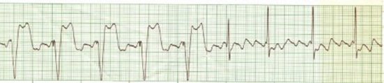 Atrial Flutter/Demand Pacemaker