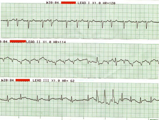 Atrial Fibrillation
