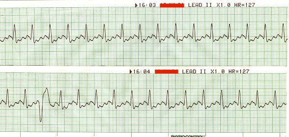 Atrial Flutter