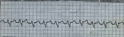 Sinus Rhythm/MI