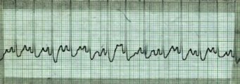 Superventricular Tachycardia