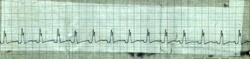Sinus tachycardia