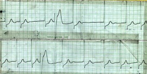 Atrial Fibrillation / Ahsman's Phenomenon