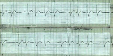 A. Fib or is it?