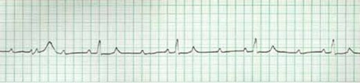 EKG 2 - Mobitz II