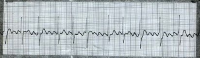 Atrial Flutter