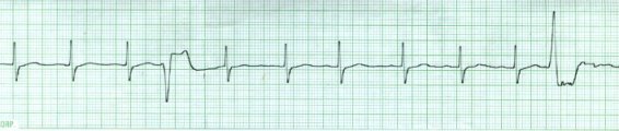 Sinus with PVCs