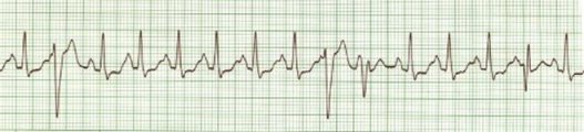 Sinus Tach/PVCs
