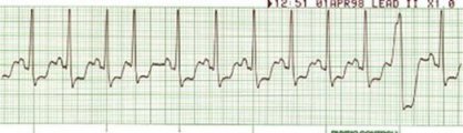 Sinus Tach/PACs