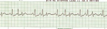 SInus rhythm with PACs/PVCs