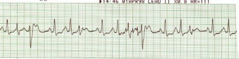 Sinus with PVCs