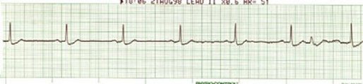 Sinus with CHB???