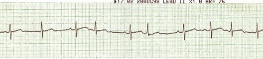 Sinus with PACs