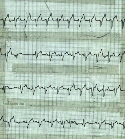 Junctional Tachycardia