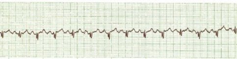 Sinus Tach with BBB