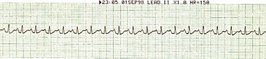 Sinus Tach