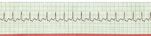 2:1 Atrial Flutter