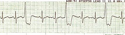 Ventrcular Trigeminy