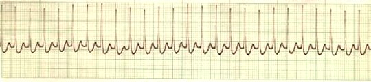 Atrial Tachycardia-SVT