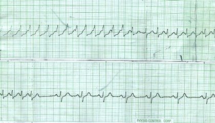 Paroxysmal Atrial Tachycardia